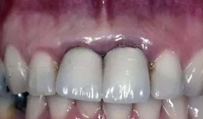 Bọc răng sứ tại địa chỉ không uy tín gây ra nhiều nguy hại