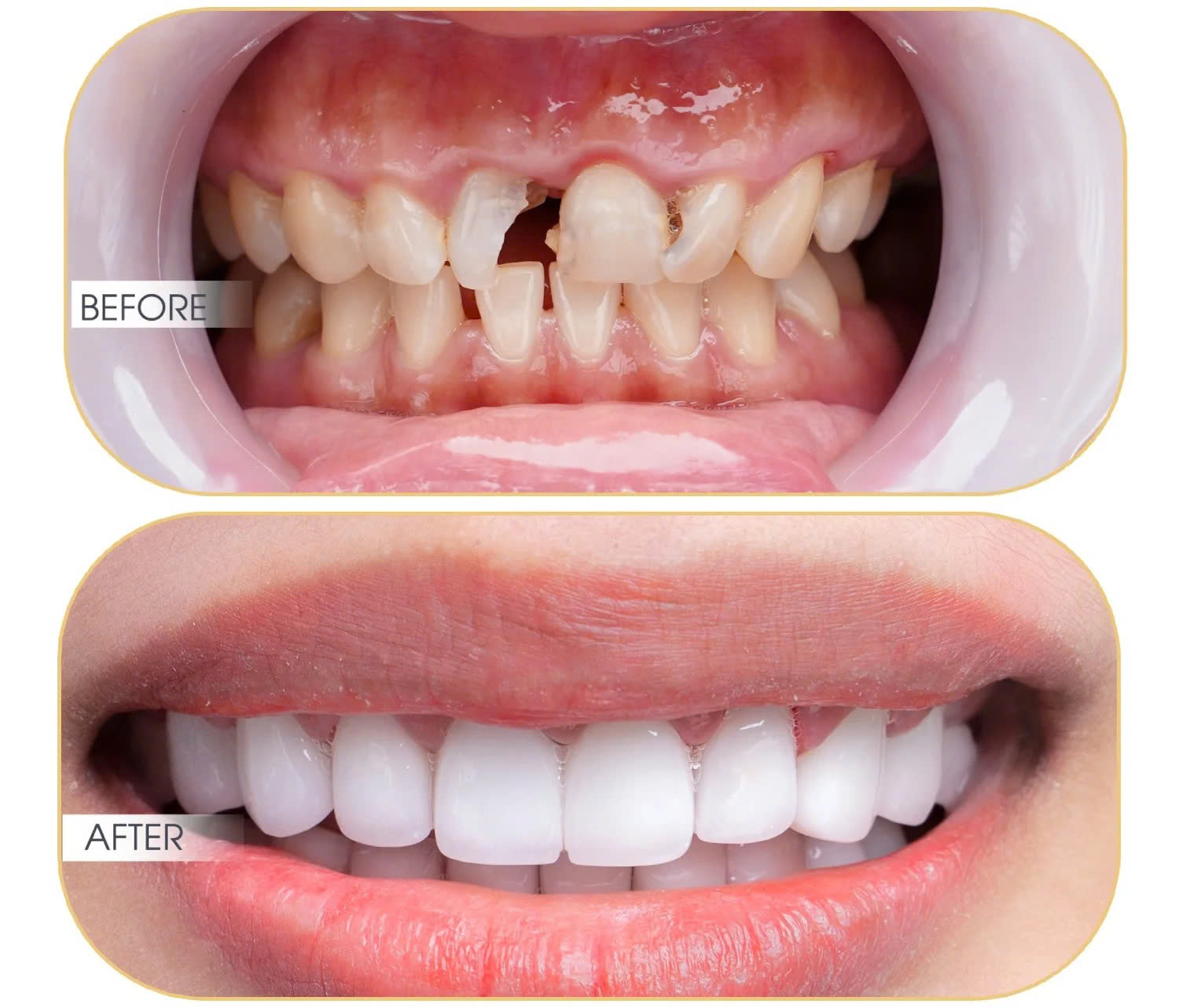Bọc răng sứ tại địa chỉ uy tín