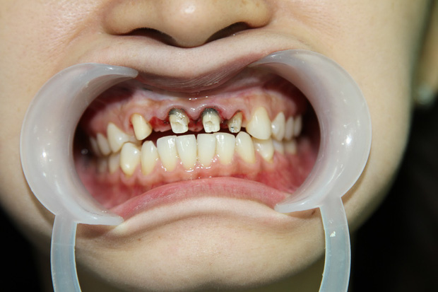 Răng sứ thẩm mỹ không đẹp và an toàn như bạn tưởng