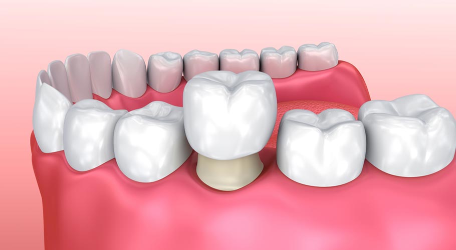 Bi Hài Chuyện Đi Bọc Răng Sứ Giá Rẻ