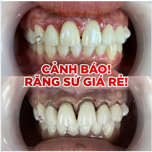 Bọc răng sứ giá rẻ