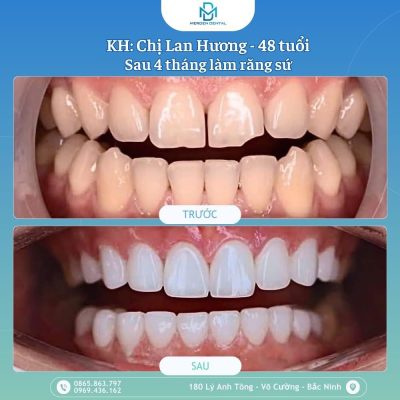 Gặp lại chị Lan Hương sau 4 tháng hoàn thiện nụ cười tại nha khoa Merden