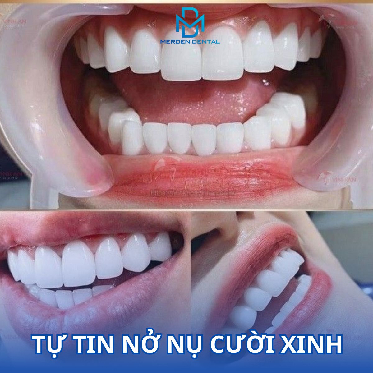 Nụ cười xinh không còn là mơ ước tại Nha Khoa Merden