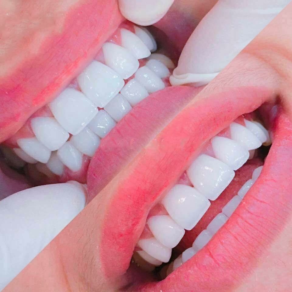 Nụ cười xinh mang lại sự tự tin