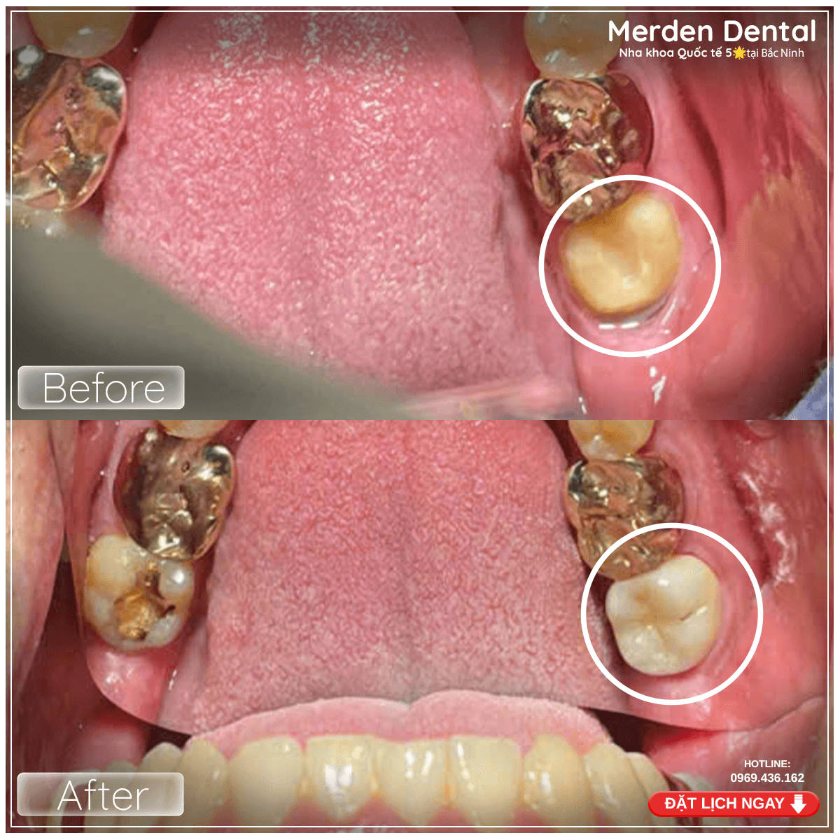 Điều Trị Tủy Răng Và Phục Hình Răng Sứ R37