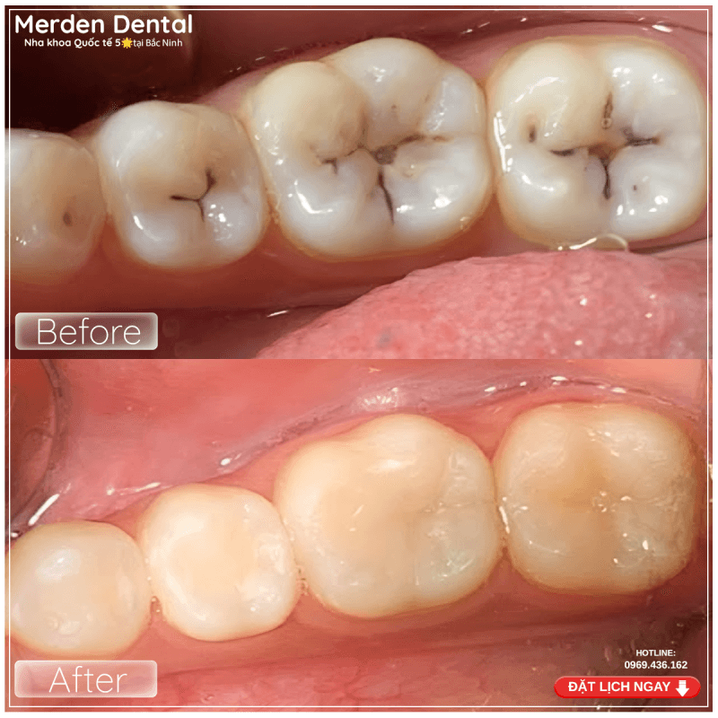 Before After Hàn Trám Răng Sâu