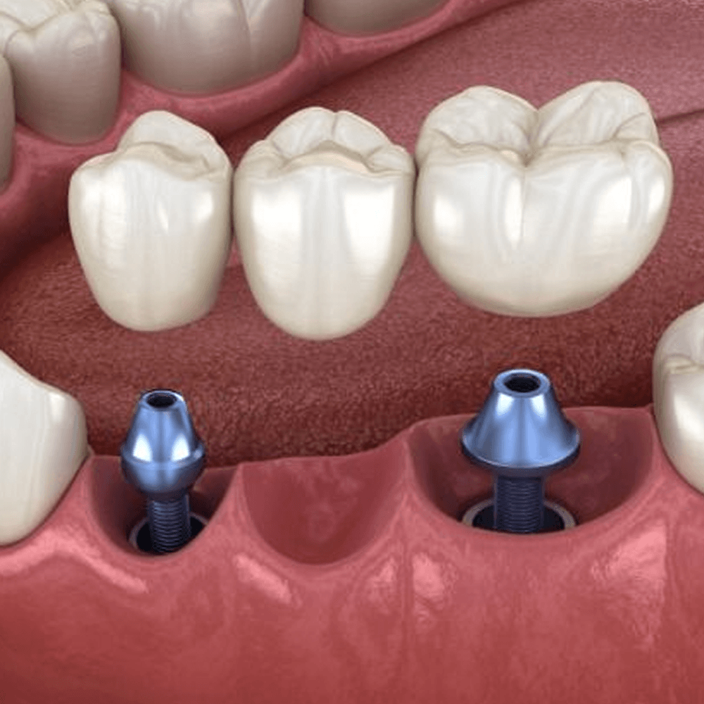 Cầu Trên Implant